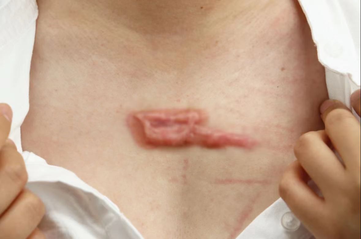 支你三招!丑陋疤痕轻松摆脱!