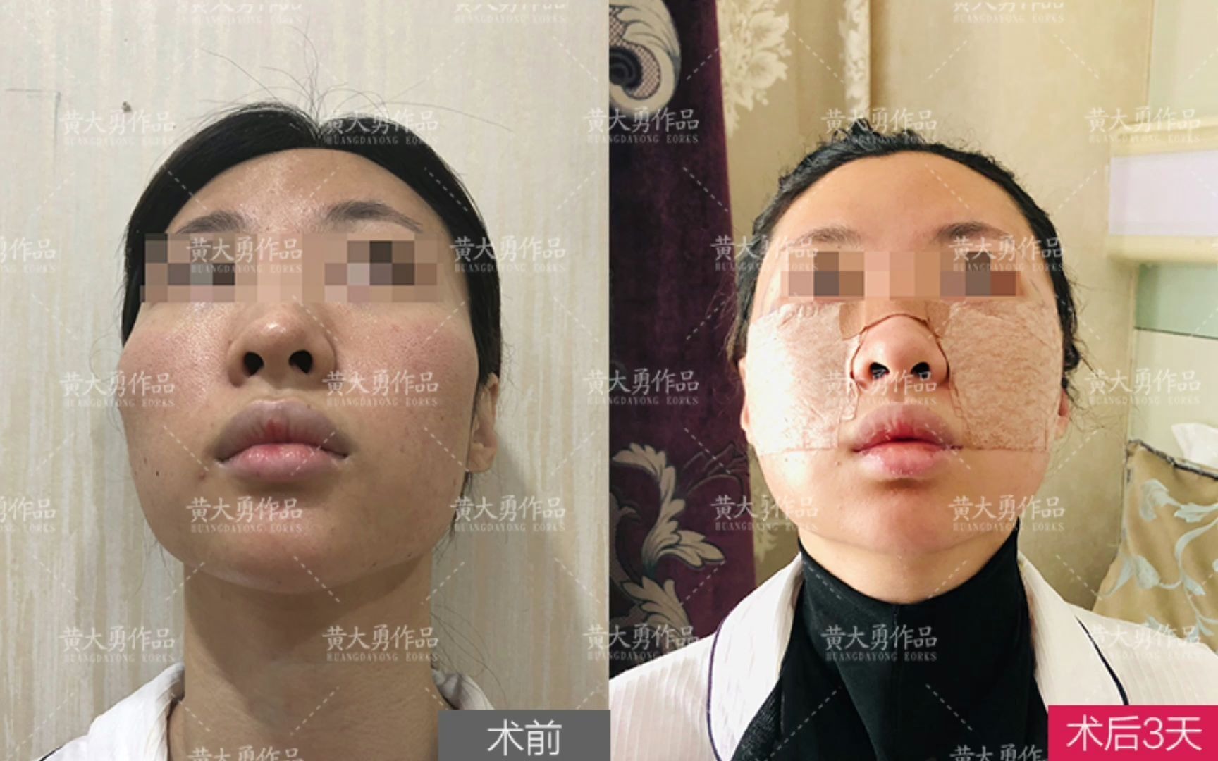 颧弓外扩比较明显,做完颧骨手术三天,肿胀还没消除