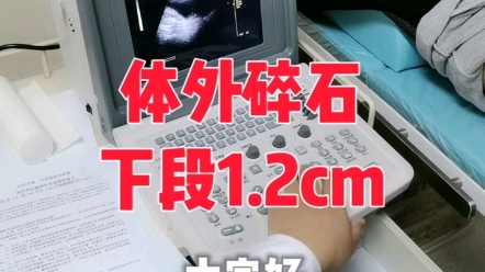 体外冲击波碎石治疗输尿管下段结石哔哩哔哩bilibili