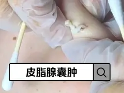 Download Video: 皮脂腺囊肿俗称粉瘤 一定要早zhiliao