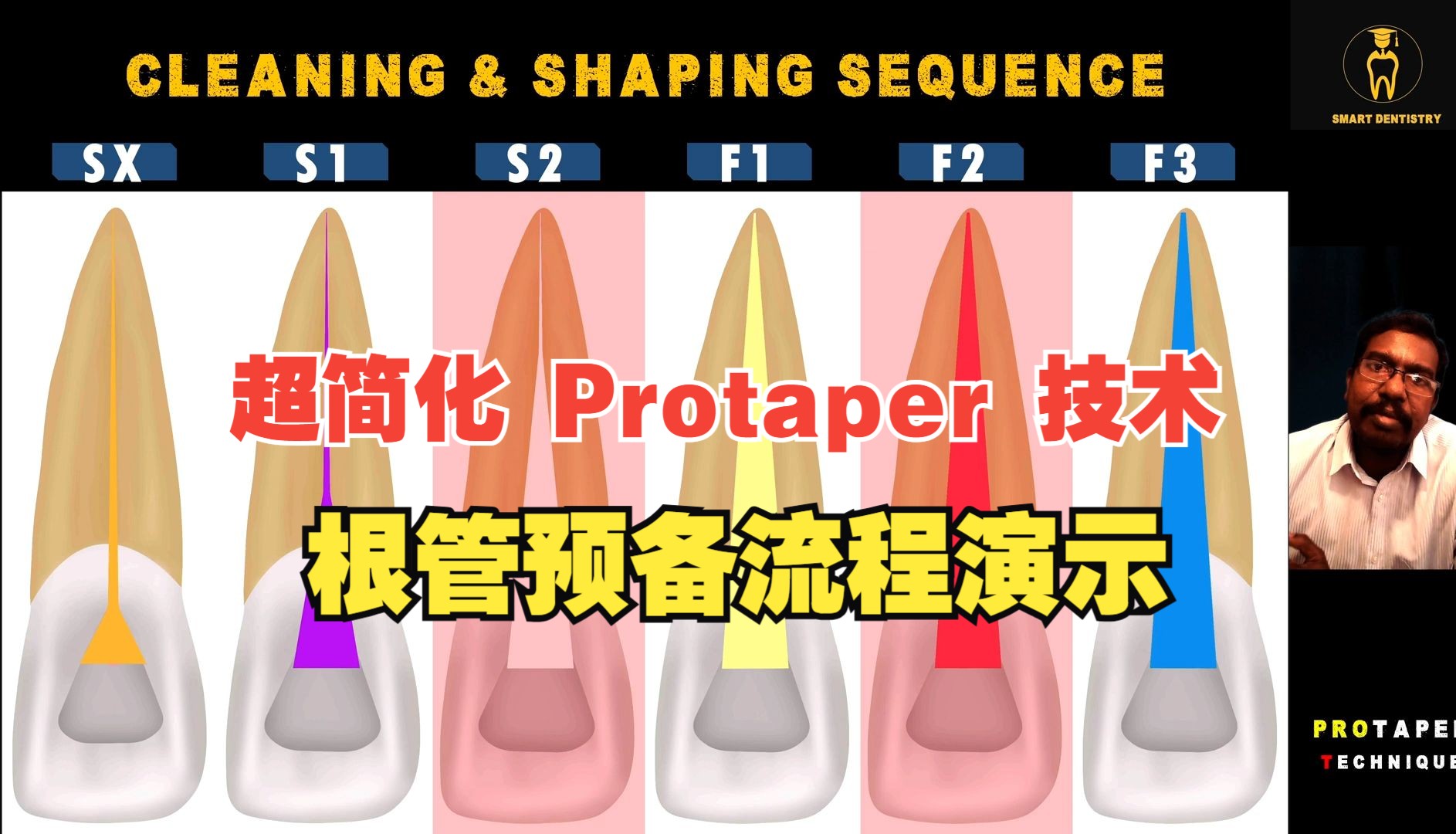 超简化 Protaper 技术:视频演示:Ultra Simplified Protaper Technique  Video demonstration哔哩哔哩bilibili