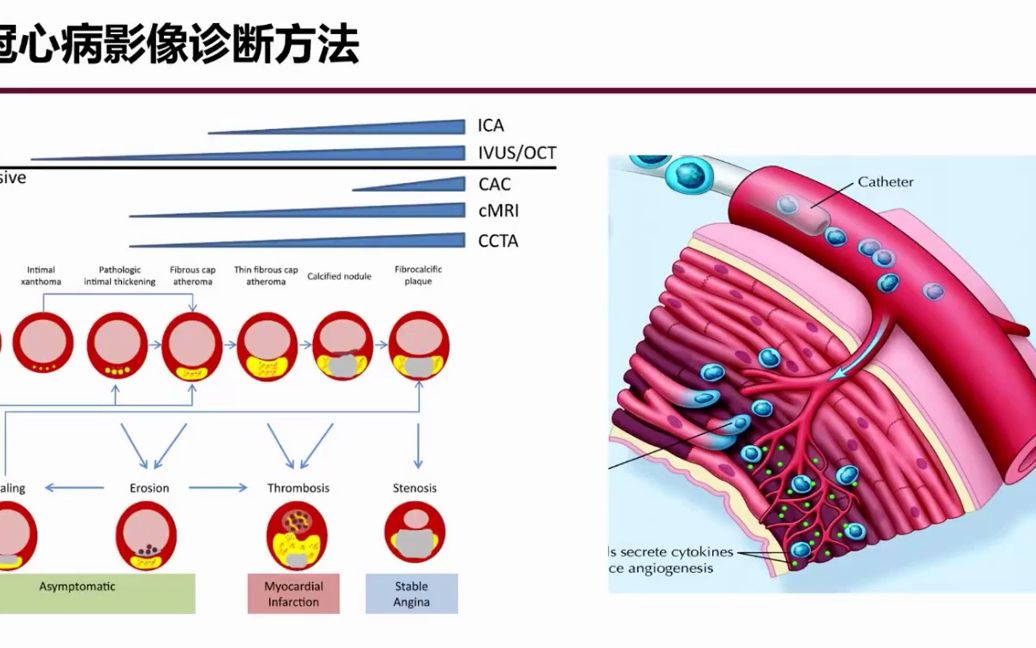 1.冠脉CTA读片规范心血管CT诊断系列1哔哩哔哩bilibili