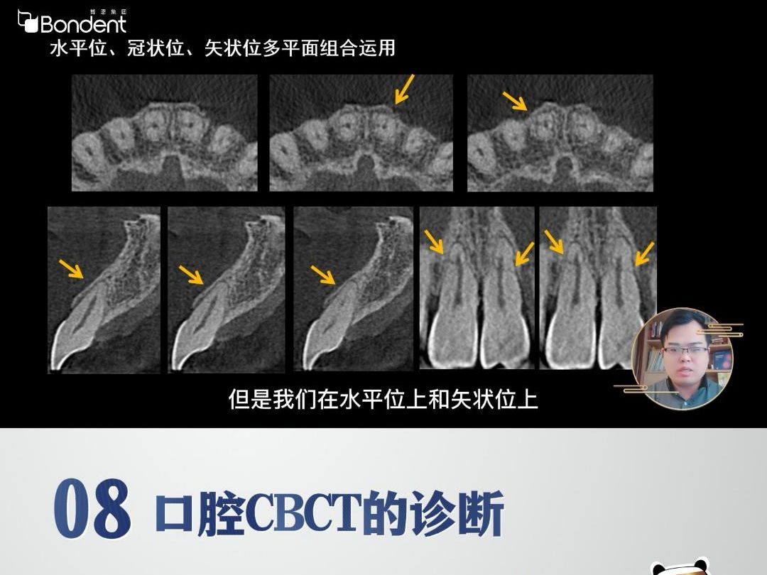 8-牙外伤-口腔cbct诊断