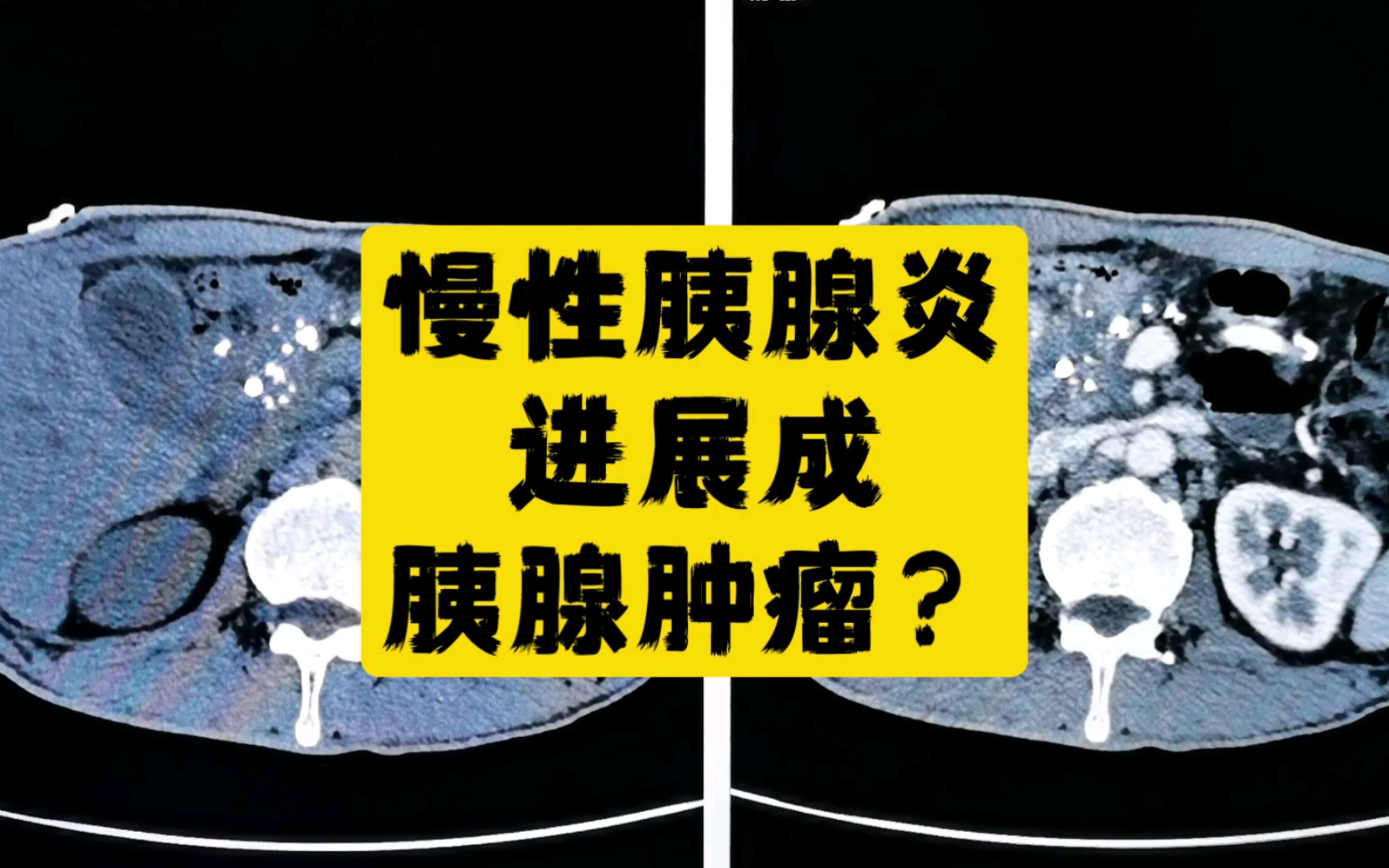 长期慢性胰腺炎,进展为胰腺肿瘤,注意周围血管情况!哔哩哔哩bilibili