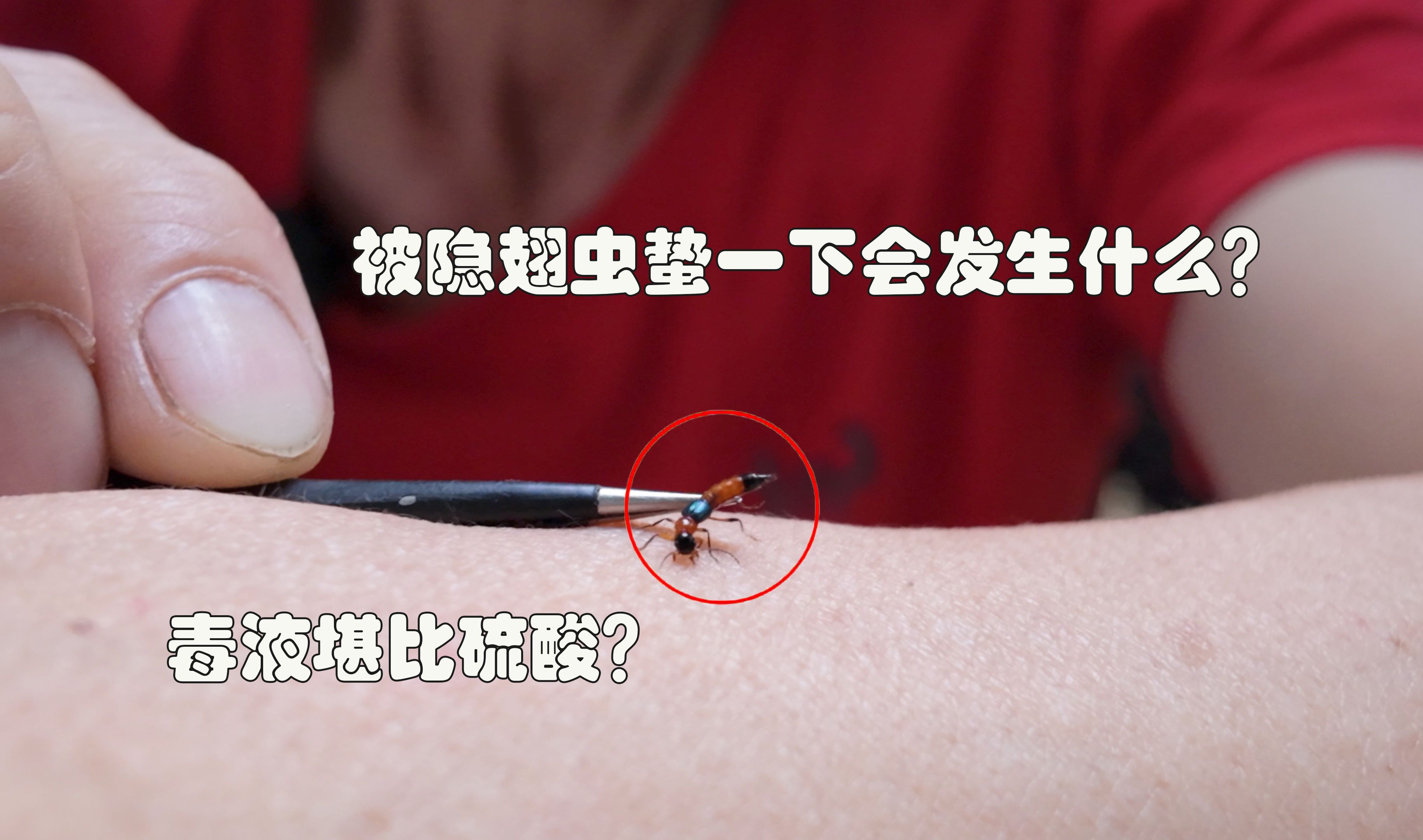 当被隐翅虫蛰一下会发生什么?毒液堪比硫酸是真的吗?测试全过程
