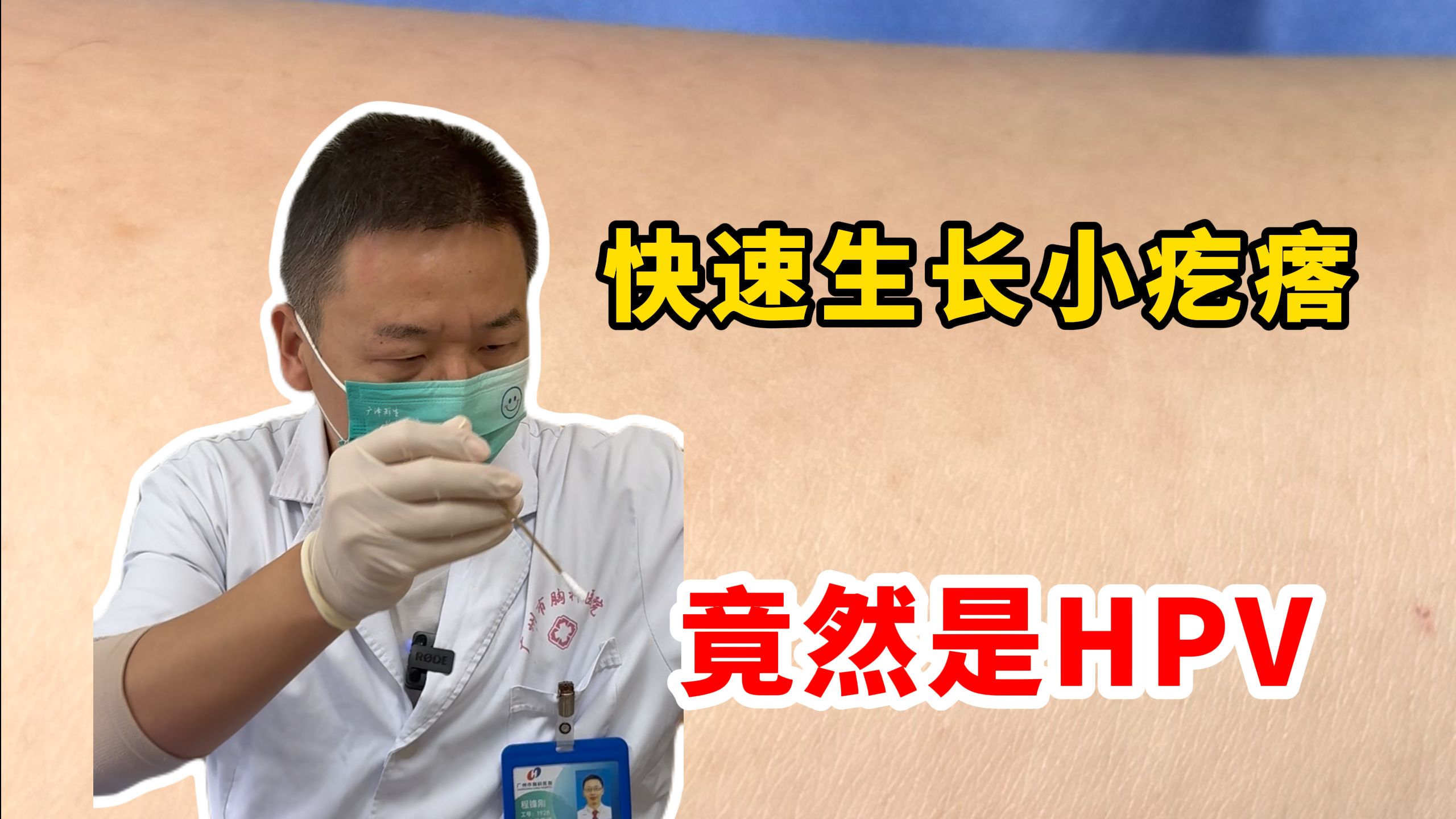 快速生长的小疙瘩 竟是HPV