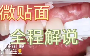 Download Video: 前牙局部微贴面粘结操作视频