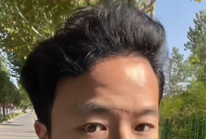 植发后半年了植发区痛(植发半年了还是感觉很少)
