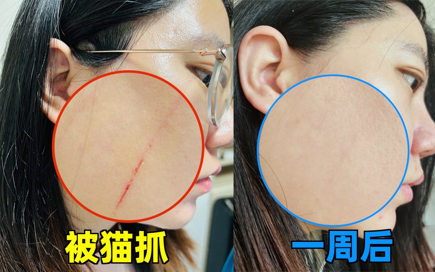 亲身经历,被猫抓伤后毁容,紧急用药一周后不留疤_哔哩哔哩_bilibili