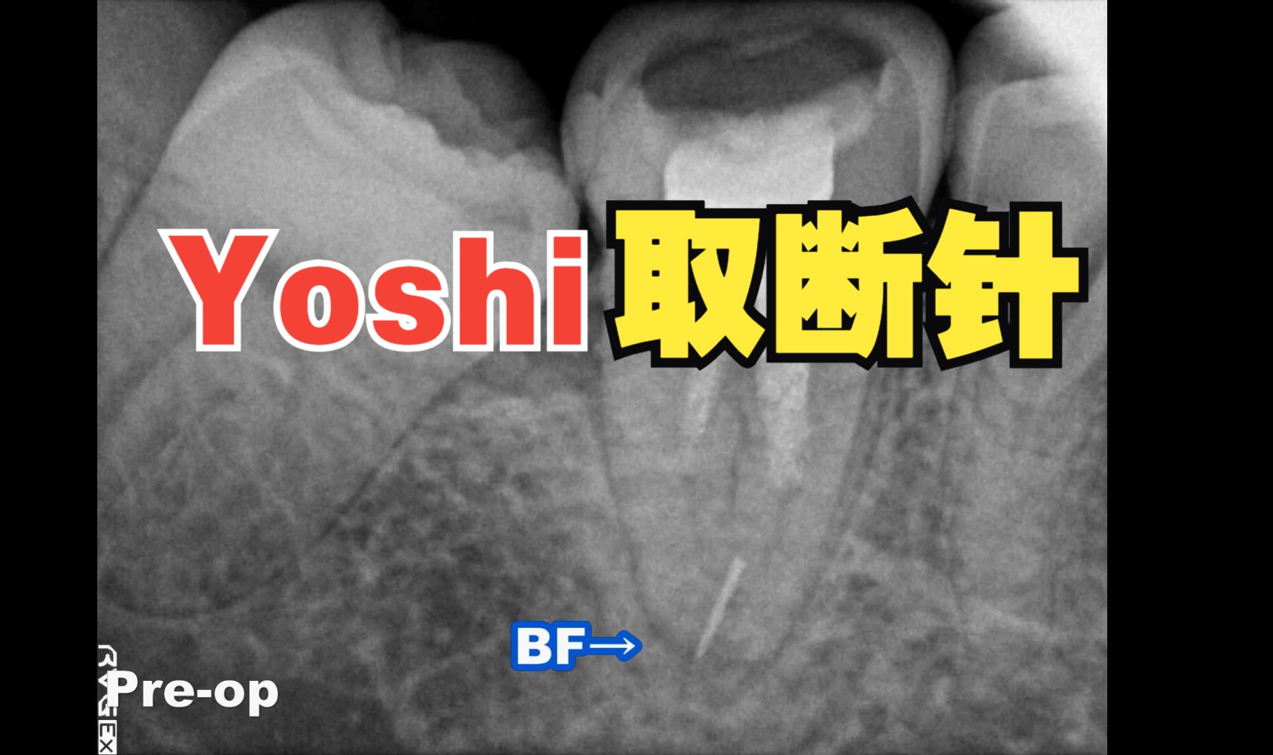 看Yoshi取个折断器械(unique techniqe to remove broken files奇抜な破折器具除去方法)哔哩哔哩bilibili