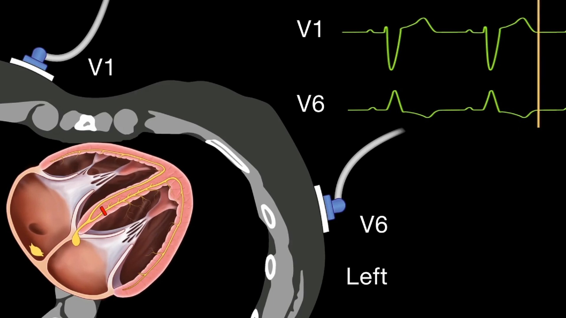 左束支传导阻滞(LBBB)哔哩哔哩bilibili