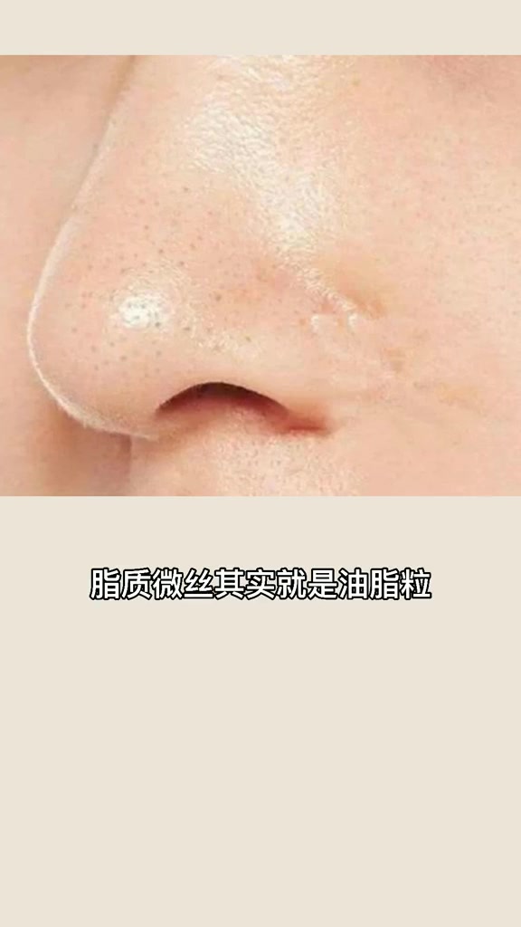 黑头分几种,记得一定要看到最后哈,教你教你!!!哔哩哔哩bilibili