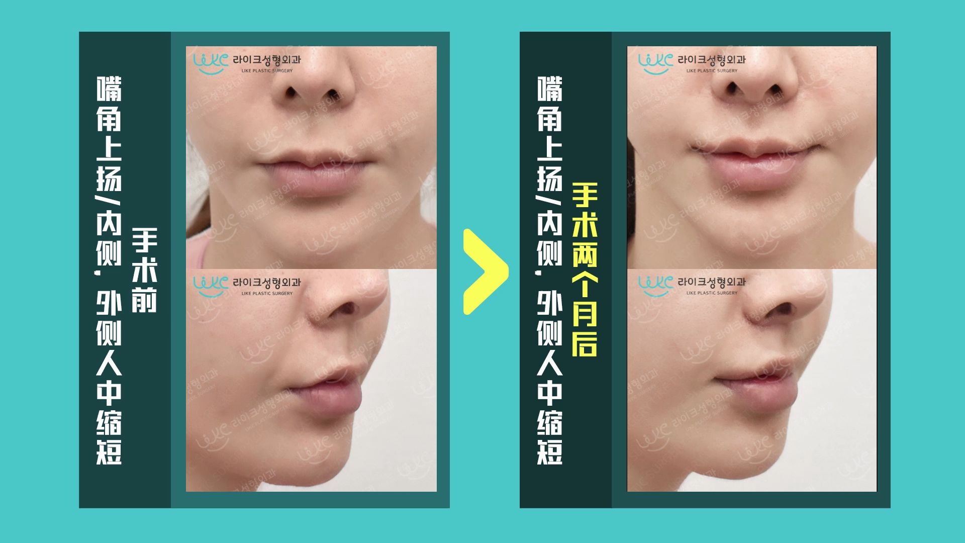 BEFORE&AFTER PHILTRUM 嘴角上杨术+人中缩短术哔哩哔哩bilibili