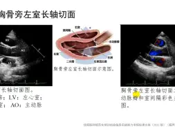 Download Video: 胸骨旁左室长轴切面