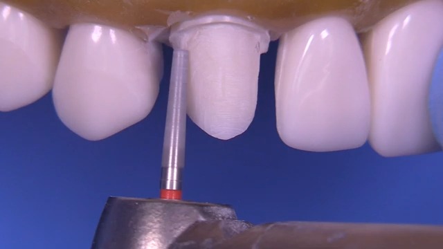 PFM Preparation on The Canine Tooth #6 Kilgore Stevenson Dental Solutions金瓷冠预备哔哩哔哩bilibili