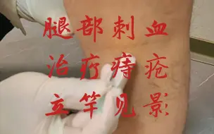 Tải video: 腿部刺血治疗痔疮