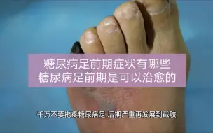 Télécharger la video: 糖尿病足前期征兆，糖尿病患者对糖尿病并发症最震撼的应该就是糖尿病足了，在线上可以看到各种案例，看完之后心里就害怕，糖尿病足是有前期征兆的，千万不要拖成糖尿病足