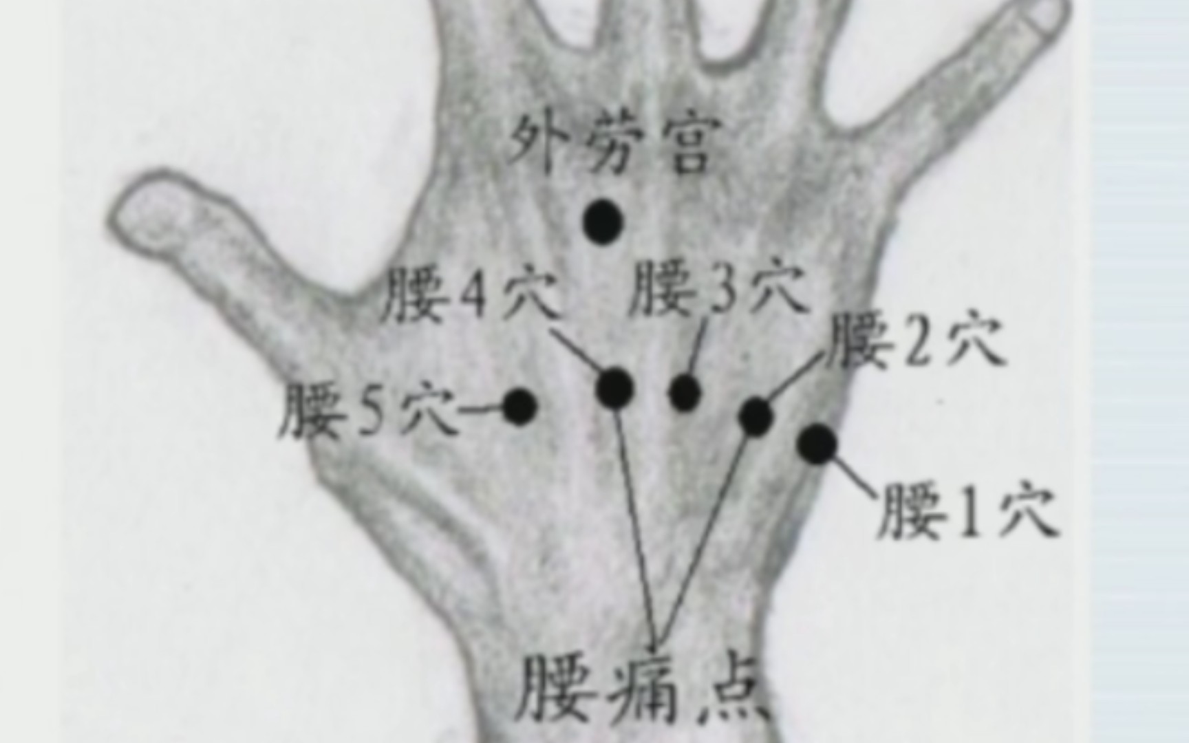 [图]经外奇穴治疗所有定点腰痛（包括腰椎间盘突出，急性腰扭伤，结石压迫疼痛等）