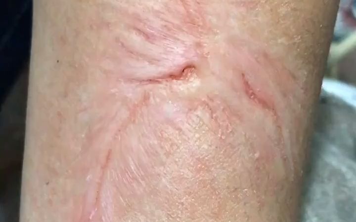 【特效化妆】影视特效化妆增生性疤痕