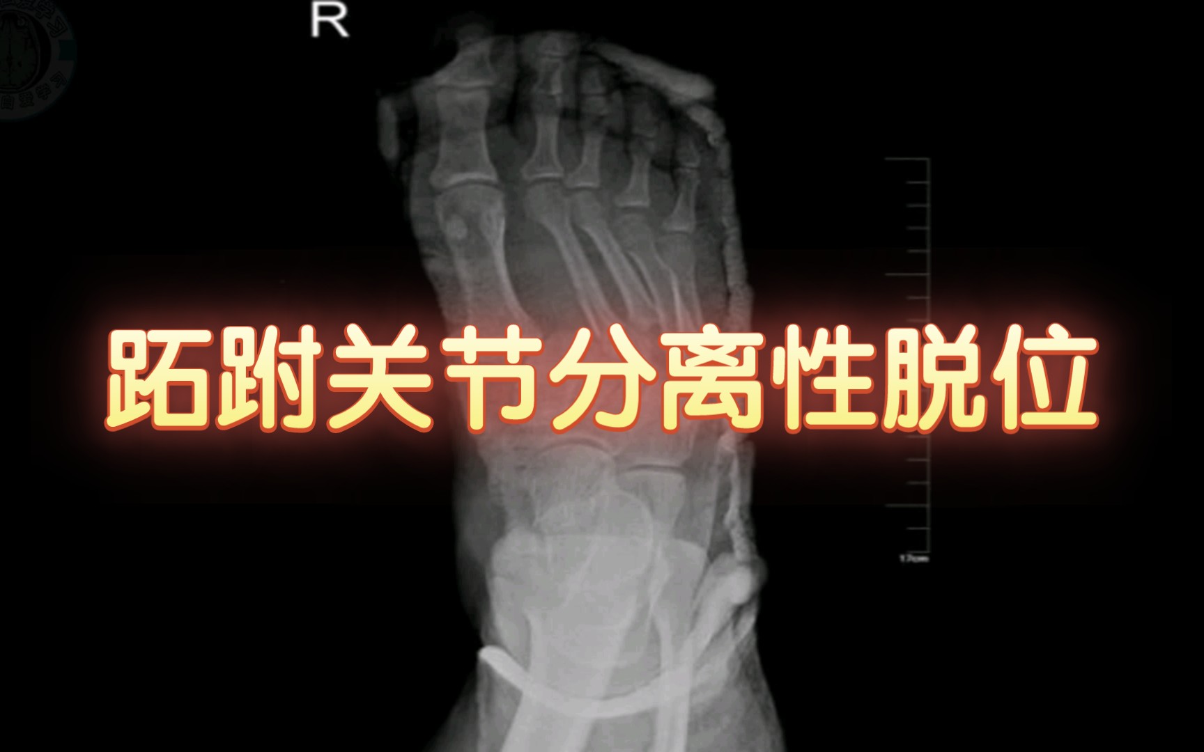 17.跖跗关节分离性脱位—读片系列骨肌系统哔哩哔哩bilibili