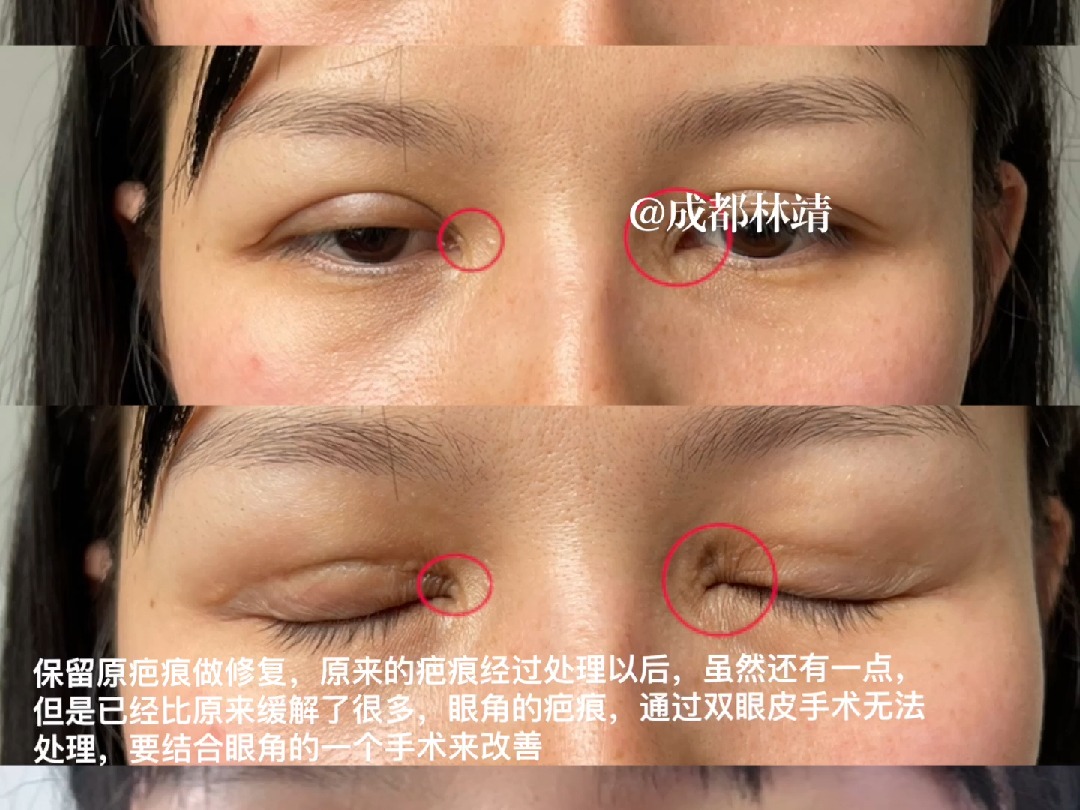 双眼皮眼角疤痕很严重的话,是改善不了的哦!