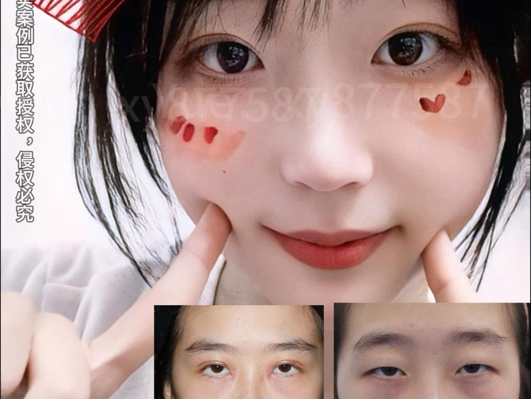 明经发双眼皮|高考完肿泡眼 小眼睛粉丝:厌世脸变甜妹脸?