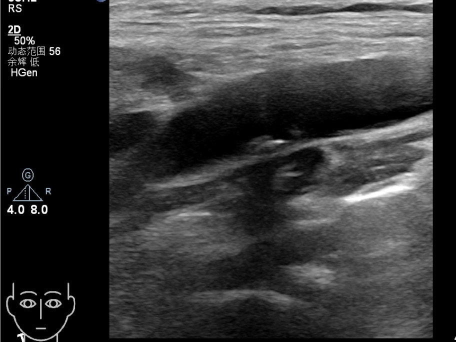颈动脉斑块超声图片
