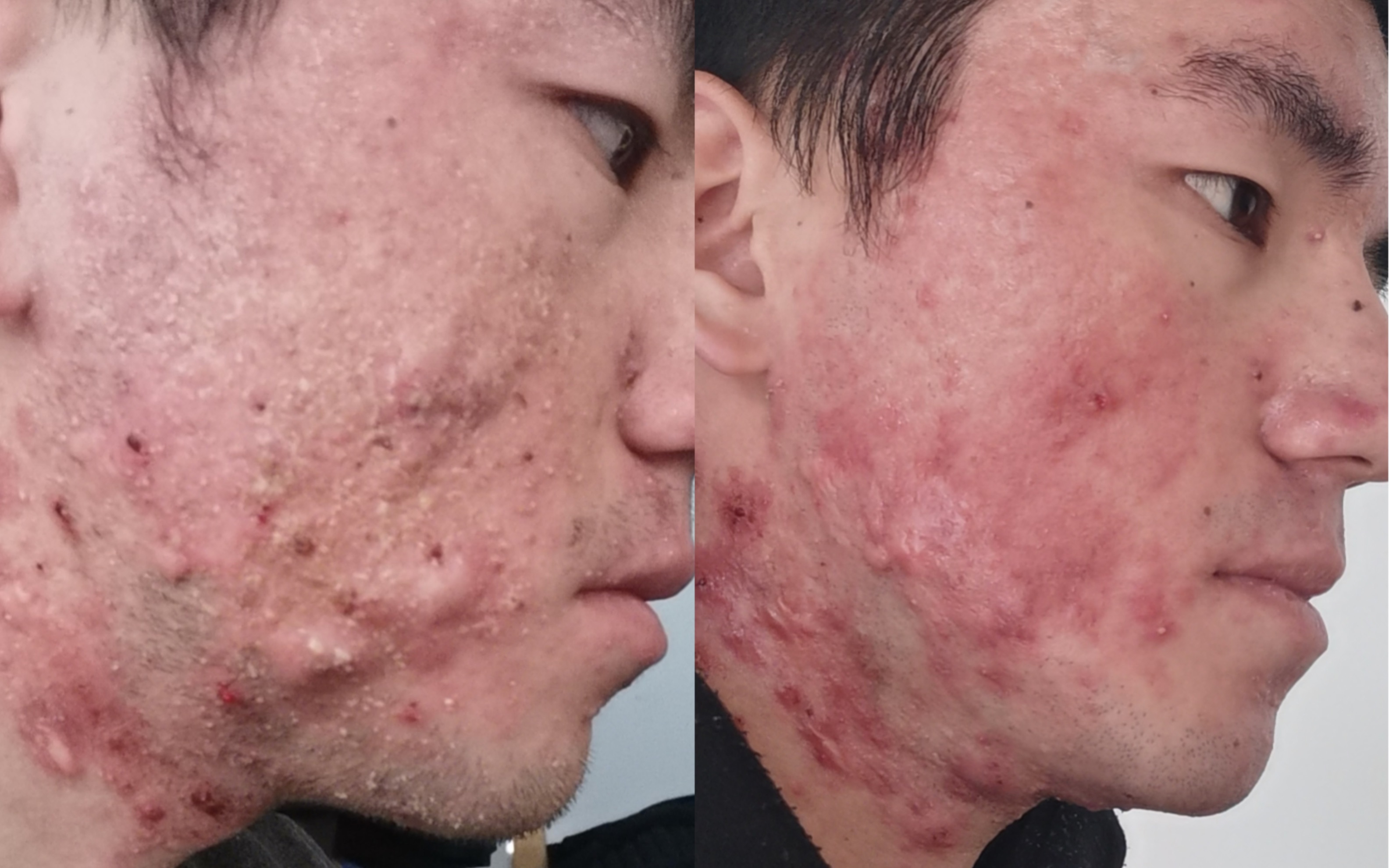 7年痘肌12天痘痘没了,但15天严重了怎么回事?