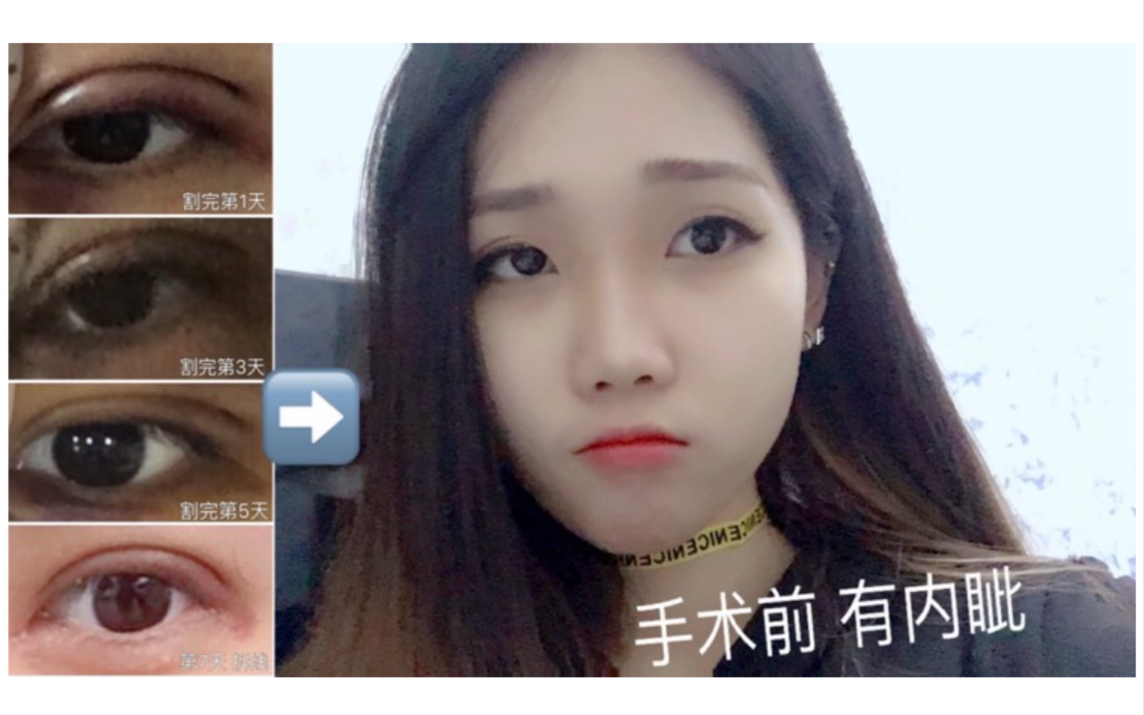 part 1 割双眼皮/全切双眼皮/整形心路历程/double eyelid surgery哔哩哔哩bilibili