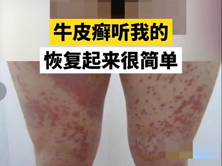 牛皮癣听我的,收下这份表,其实不难