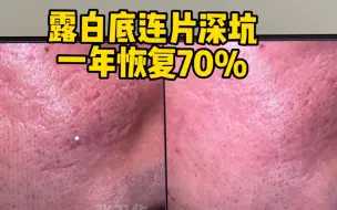 Скачать видео: 露白底深痘坑，一年恢复70%怎么做到的？！超真实visia图反馈。