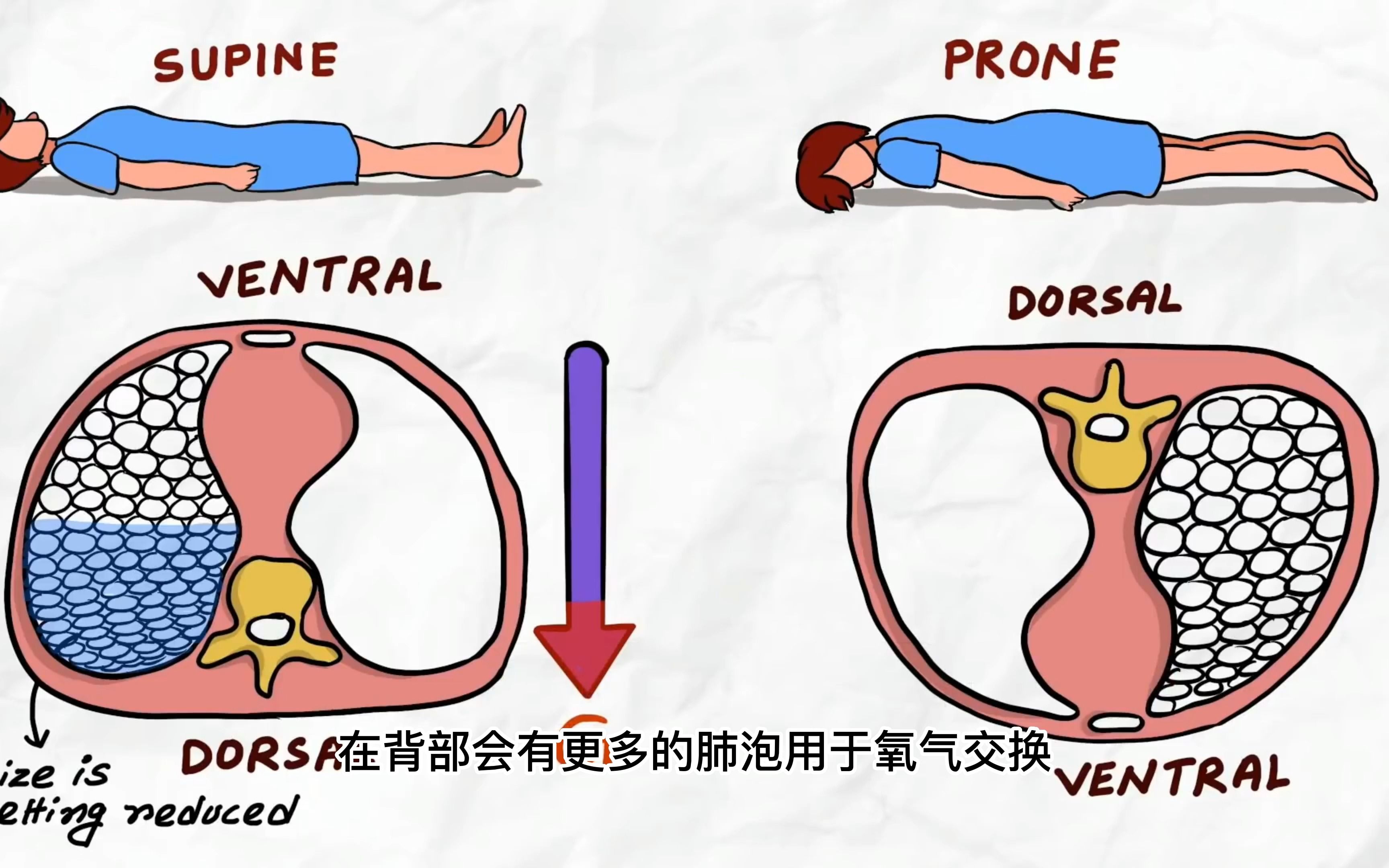 多少人被救活?这个冬天我们最该科普的医学知识-俯卧位通气