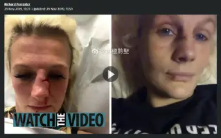 鼻骨折了 搜索结果 哔哩哔哩弹幕视频网 つロ乾杯 Bilibili