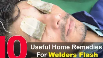 Top 10 Home Remedies To Treat Welder's Flash - Eye Pain Home Remedies