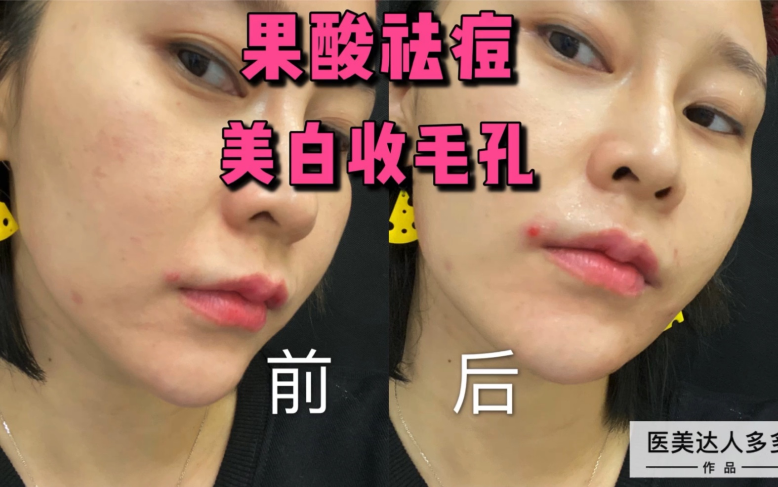 果酸祛痘,淡化痘印美白收毛孔,白菜价百十块的医美