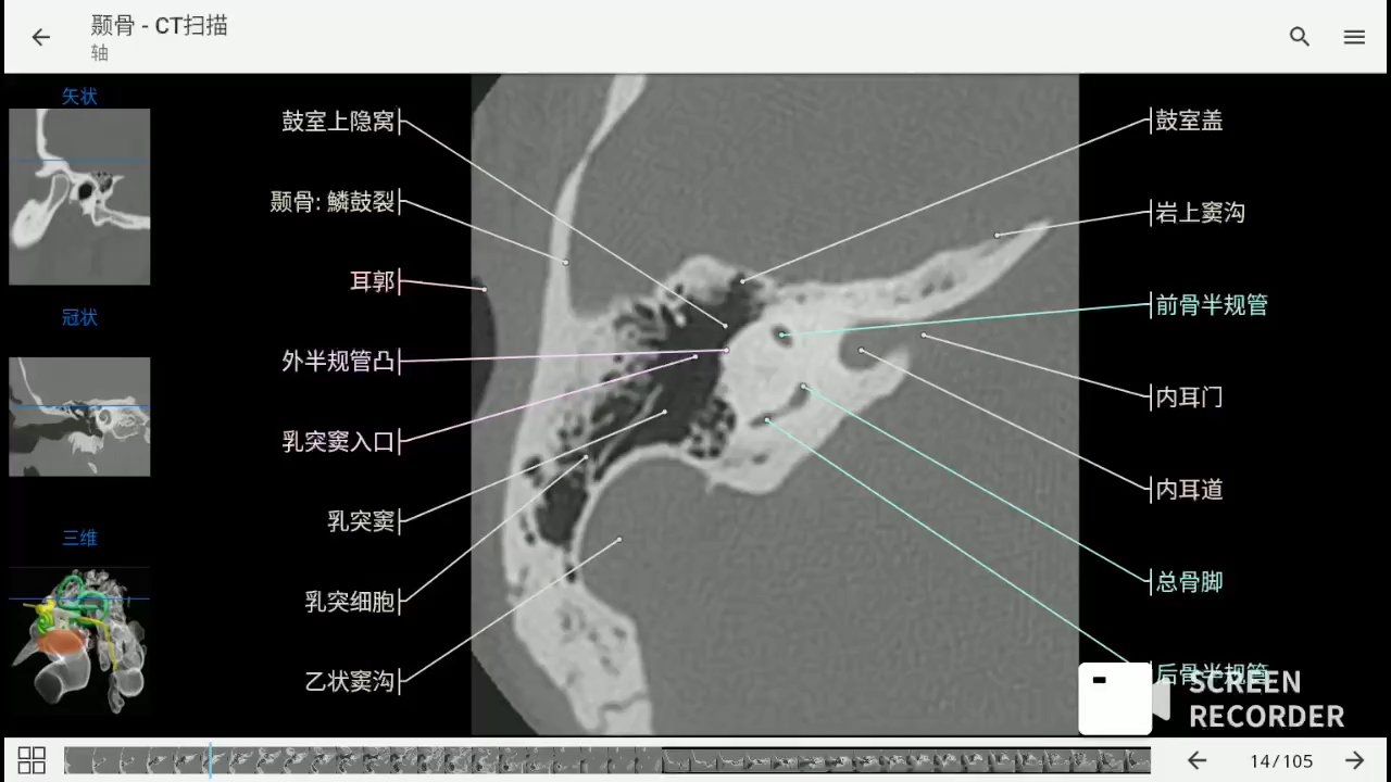 [图]影像解剖图谱神器 医学影像学必备 e-anatomy中文最新版 颞骨岩部CT