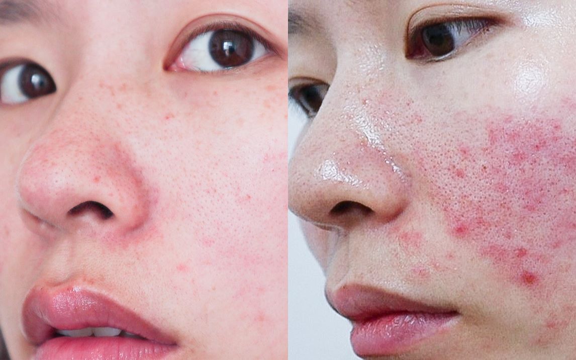 活动作品因为刷酸我差点烂脸毁容