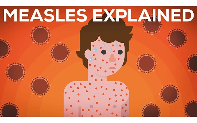 [图]Measles Explained — Vaccinate or Not?