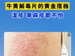 Download Video: 牛黄解毒片的 黄金搭档 湿疹 荨麻疹都不怕