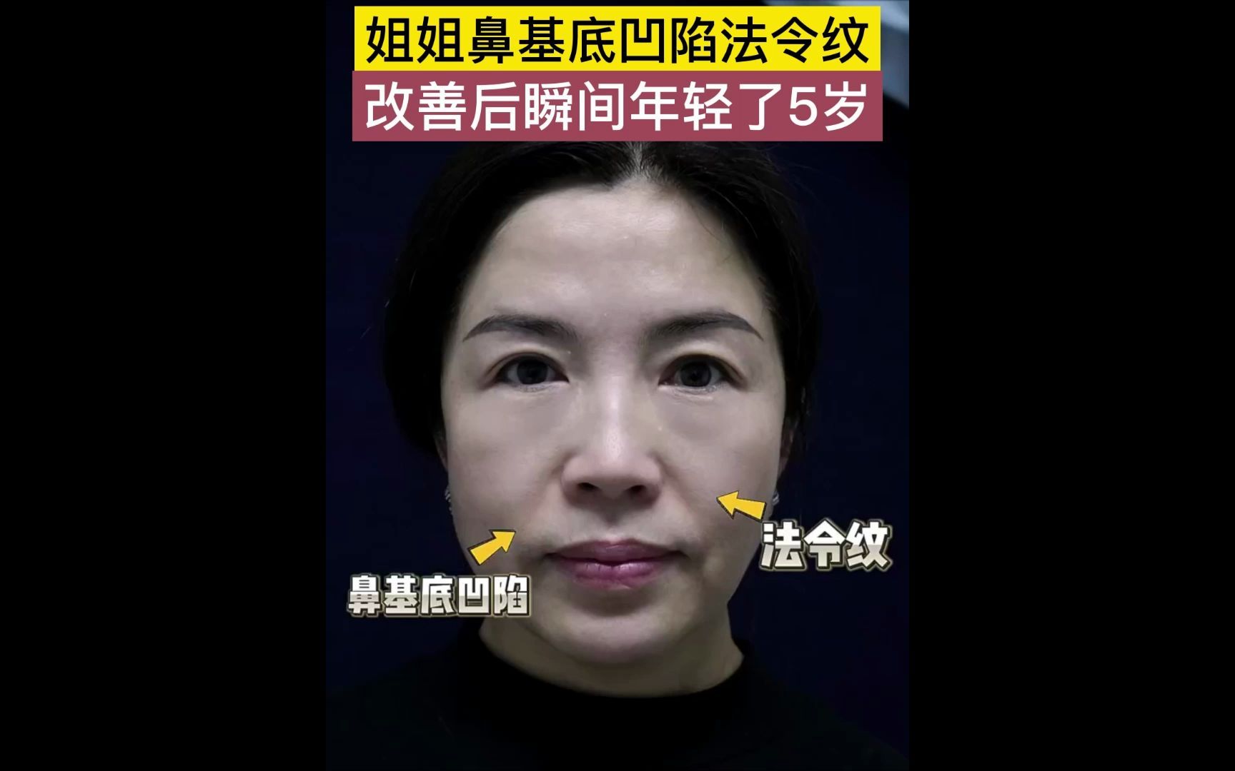 鼻基底凹陷伴随法令纹,改善后瞬间年轻5岁