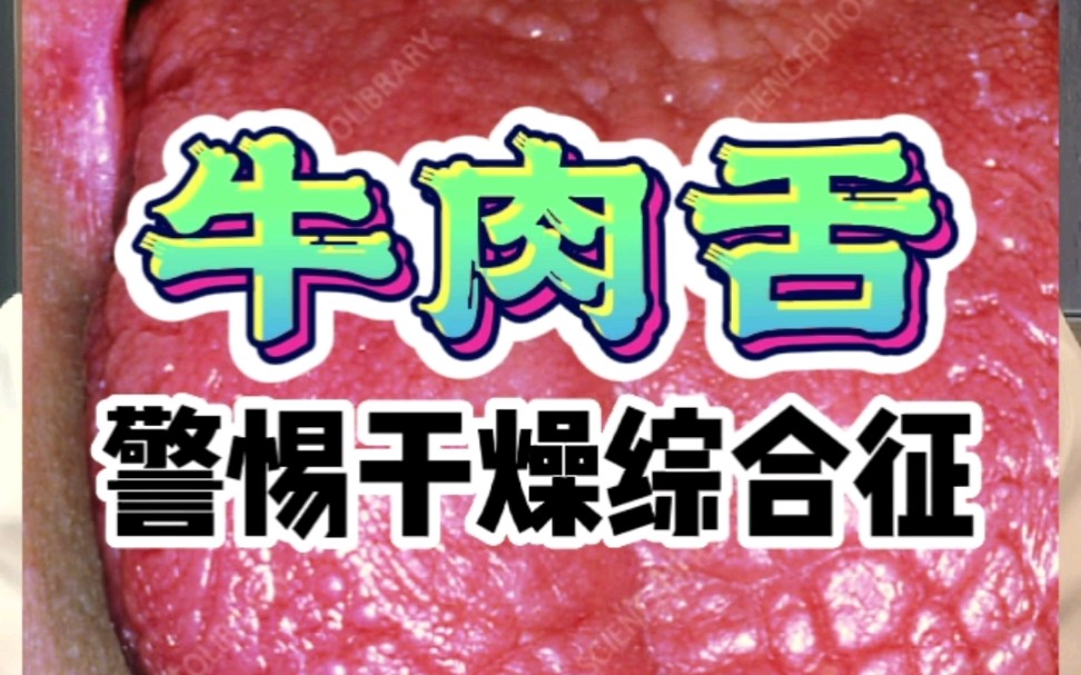 牛肉舌 警惕干燥综合征!哔哩哔哩bilibili