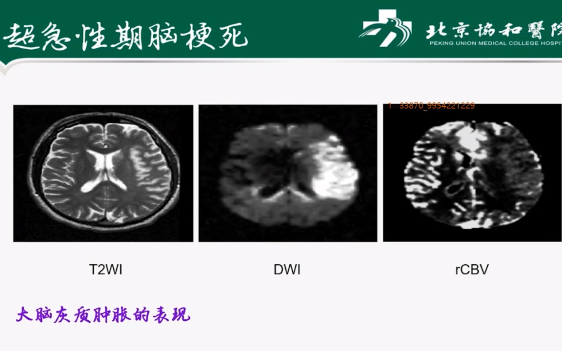 北京协和医院 冯逢脑血管病的MRI检查要点及诊断思路哔哩哔哩bilibili