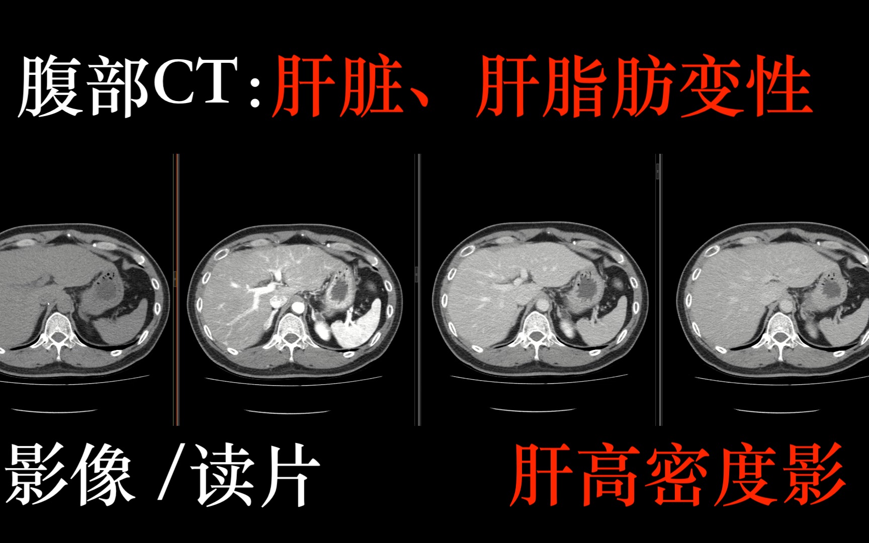 [图]腹部 CT/读片 -肝脏，肝脂肪变性，肝高密度影