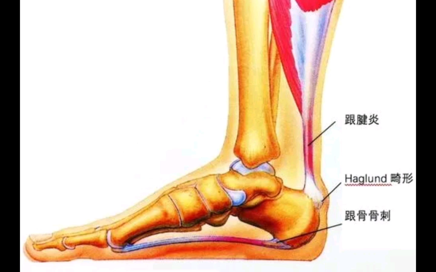 小腿肚低跟腱短图片