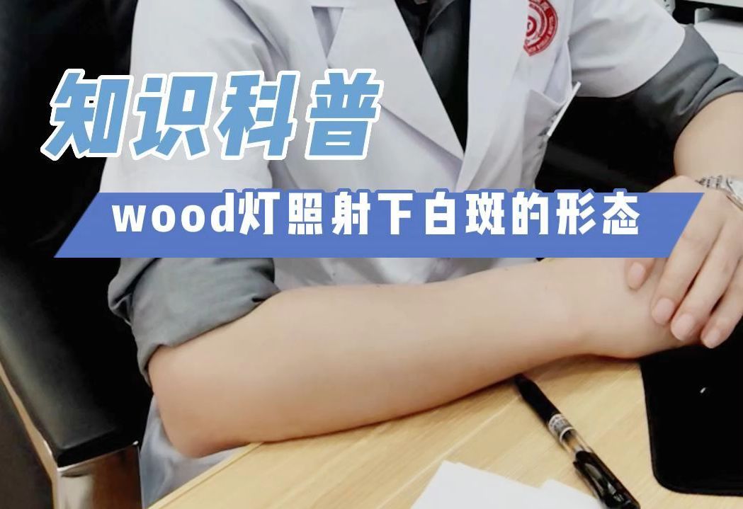 长沙博润|长沙白癜风医院:wood灯照射下白斑的形态哔哩哔哩bilibili