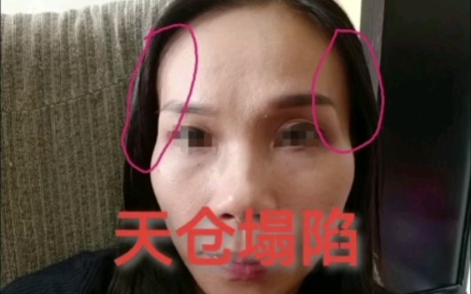 【面相知识】之天仓塌陷哔哩哔哩bilibili