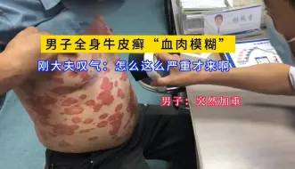 Download Video: 男子全身牛皮癣“血肉模糊”，刚大夫叹气：怎么这么严重才来啊