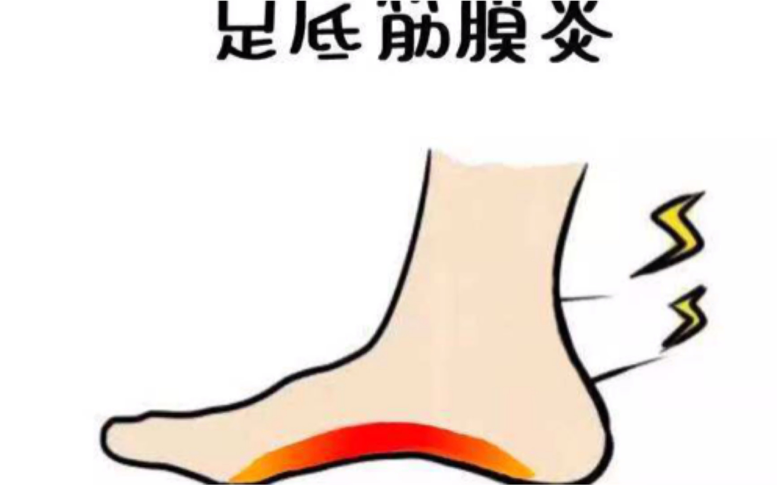 足底筋膜炎足跟痛4个动作帮你康复