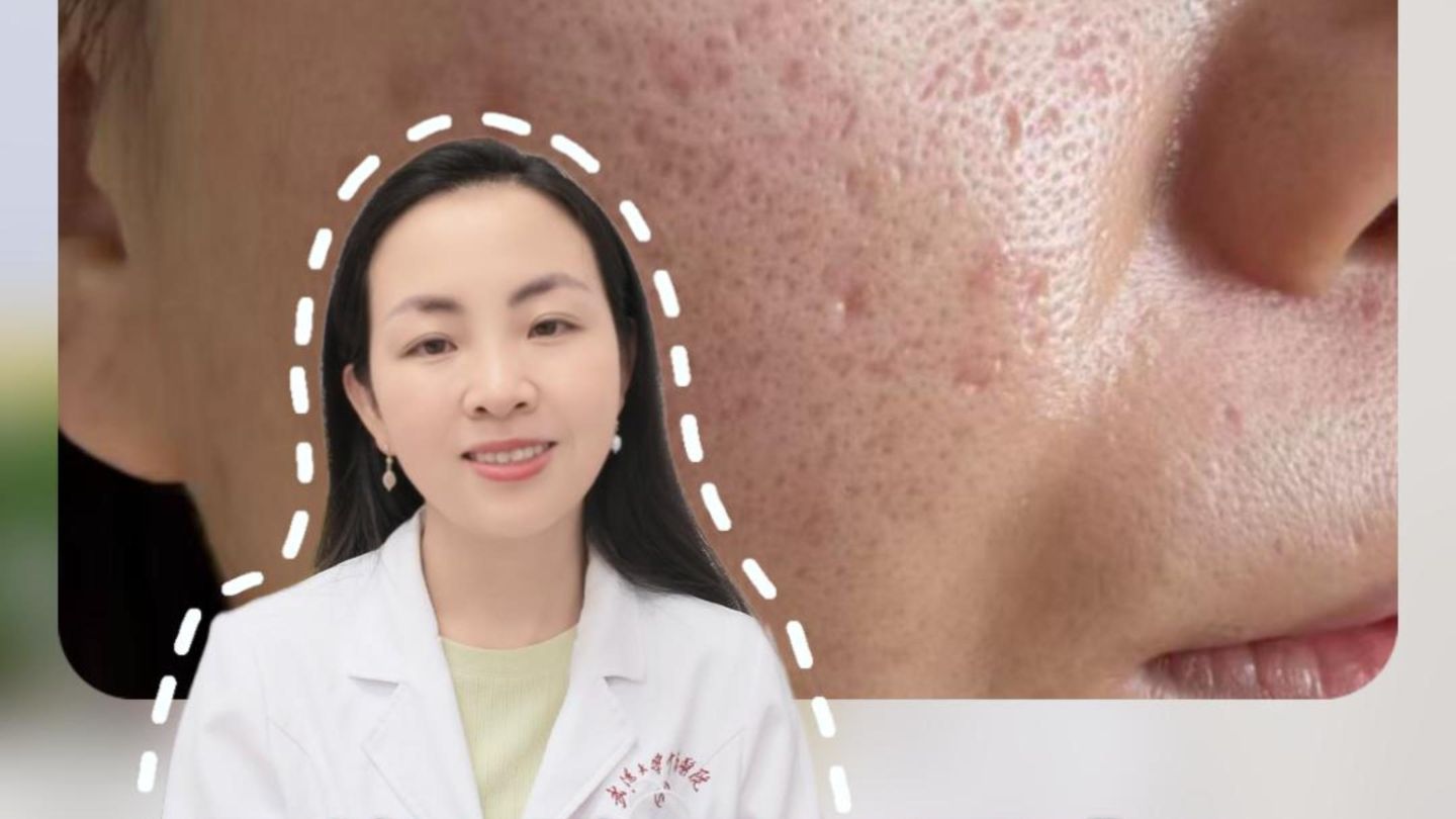异维 A 酸要不要吃？三甲医生一次说清！