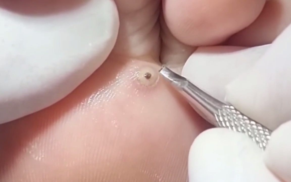 一颗害羞的小鸡眼